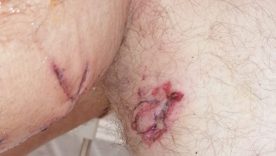  Tată mușcat de câini salvează fetița de 6 ani de la atacul feroce!